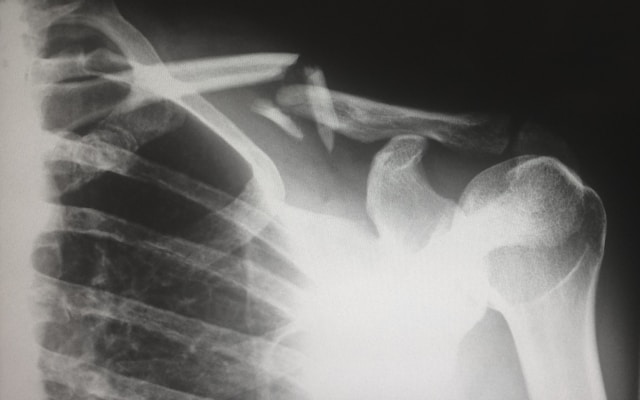 Why You Need a Workplace Injury Lawyer: Protecting Your Rights After an Accident